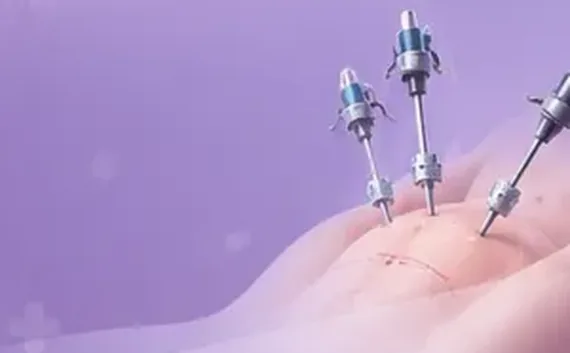 Laparoscopic instruments at a keyhole incision