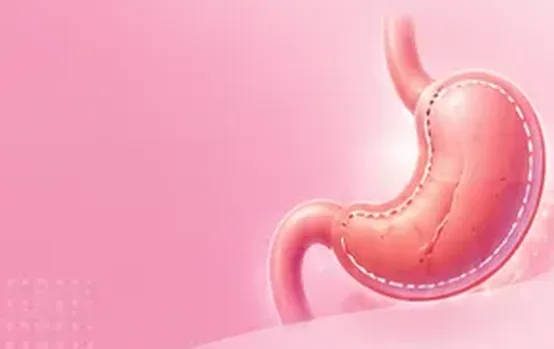 Illustration of a stomach after sleeve surgery